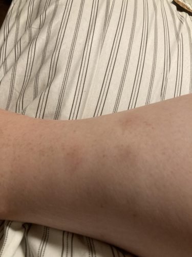 Beurer BR60 Insect Sting and Bite Relief. Bug Bite Healer for Chemical-Free Treatment of Insect Bites. Non-Toxic Natural Relief from Itching and Swelling. for Mosquito Bites photo review